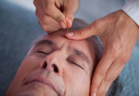Facial Acupuncture - Valley Physiotherapy Clinic